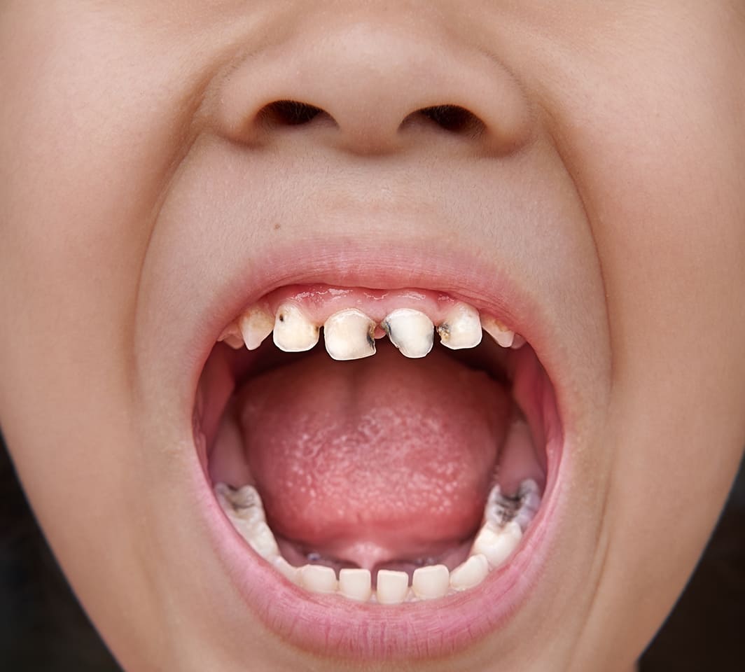 karies gigi pada anak