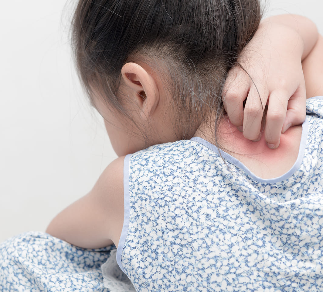 makanan penyebab alergi